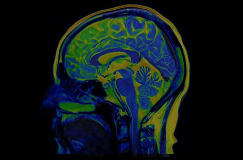 brain scan